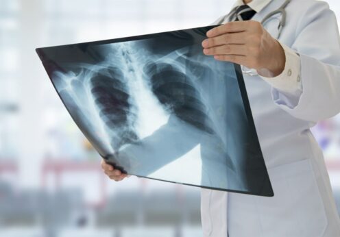 Лікування туберкульозу в Україні